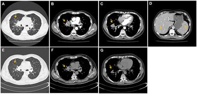 Three-year delay in diagnosis of pulmonary sarcoidosis due to presence of necrotizing granulomas: a cautionary case report